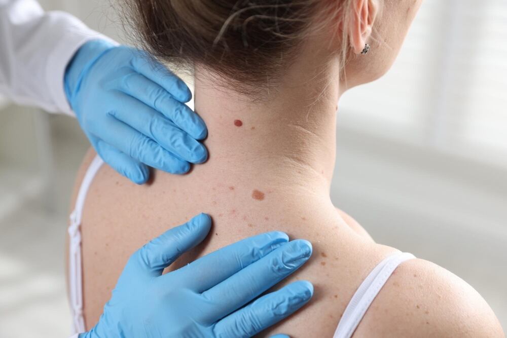 La mayoría de los lunares son benignos, pero ciertas modificaciones en su apariencia pueden indicar la presencia de cáncer de piel. Especialistas recomiendan el autoexamen y las evaluaciones médicas oportunas para favorecer un diagnóstico precoz.