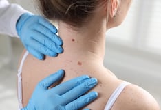 Cinco señales en los lunares que podrían alertar sobre un cáncer de piel