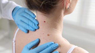 Cinco señales en los lunares que podrían alertar sobre un cáncer de piel