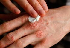 Piura: Especialista recomienda vigilar a contactos de paciente con lepra