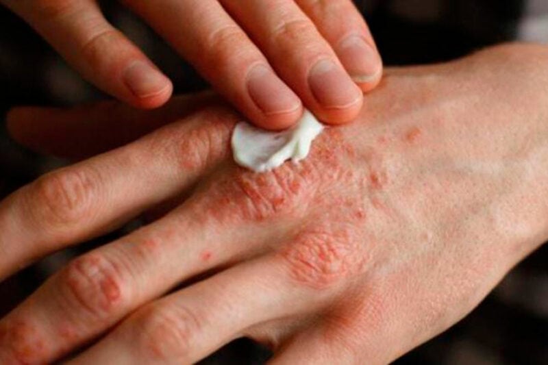 Piden buscar y monitorear a contactos del caso inicial de lepra en Piura