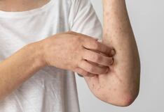 OMS declara a la viruela del mono como nueva emergencia de salud pública internacional