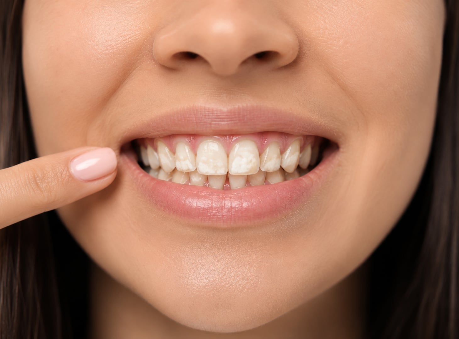 La caries no tratada afecta a unos 2.500 millones de personas en el mundo, según la OMS. Un odontólogo explica cuáles son los primeros síntomas y cómo prevenir esta enfermedad.