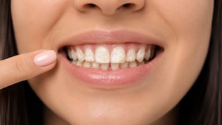 ¿Manchas blancas en los dientes? Podrían ser una señal temprana de caries, advierte especialista