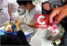 Chincha: menor casi pierde tres dedos de la mano tras explotarle pirotécnico en Navidad