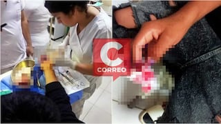 Chincha: menor casi pierde tres dedos de la mano tras explotarle pirotécnico en Navidad