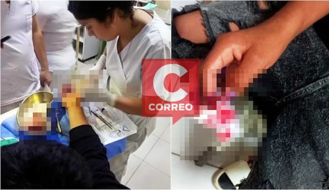 Chincha: menor casi pierde tres dedos de la mano tras explotarle pirotécnico en Navidad