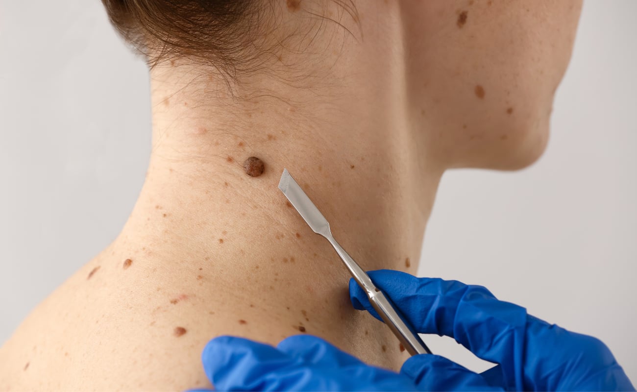 Perú registra uno de los niveles más altos de radiación ultravioleta. Expertos explican la diferencia entre rayos UVA y UVB, y cómo prevenir el cáncer de piel.