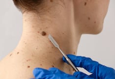 Cáncer de piel: radiación solar podría elevar en 60% los casos en el Perú