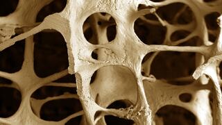 Osteoporosis: A prevenir con una buena alimentación