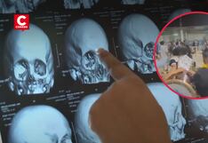 Yunza en Puente Piedra termina en brutal golpiza: ingeniero sufrió edema cerebral y fracturas