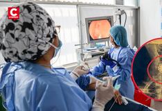 Médicos salvan la vida a adulto mayor de 81 años al retirar dentadura postiza atorada en su garganta