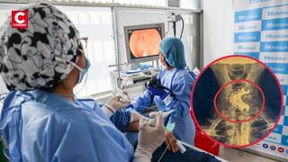 Médicos salvan la vida a adulto mayor de 81 años al retirar dentadura postiza atorada en su garganta