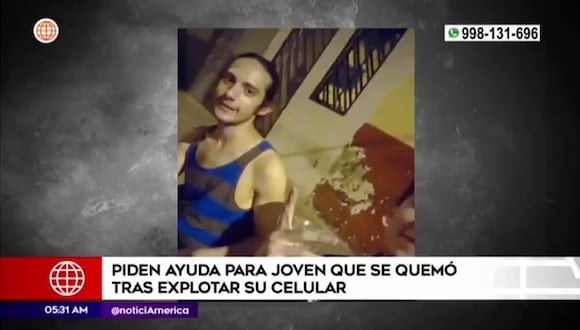 Surquillo: Joven sufre quemaduras al explotar su celular.
