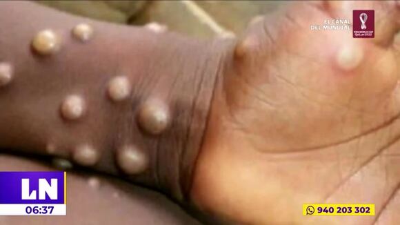 Viruela del mono: Hospitales de Ate y Villa El Salvador atenderán los posibles casos en nuestro país