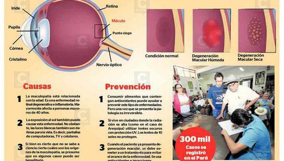 Maculopatía afecta a 300 mil peruanos. Sepa todo sobre esta enfermedad en esta nota