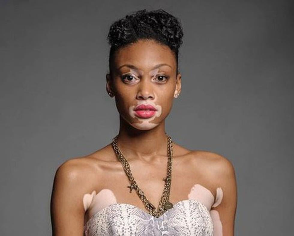 Conoce a la modelo con vitiligo que triunfa en los Estados Unidos (FOTOS)
