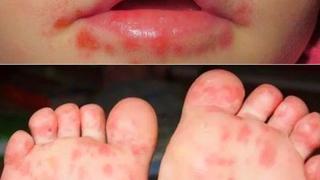 A 97 se elevan los casos del síndrome de manos, pies y boca en Piura