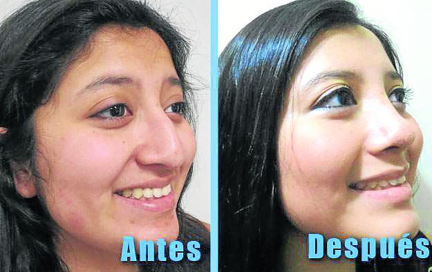 La rinoplastía es la cirugía de moda entre los huancaínos