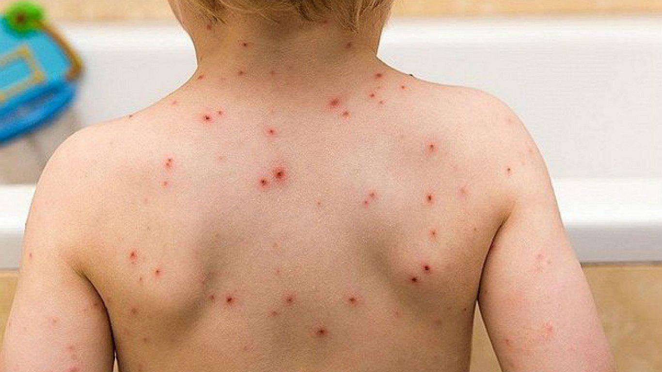 Varicela: El contagio aumentaría en temporada de verano