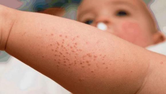 Salud: Niños sufrirán infecciones en la piel si no tratan a tiempo el sarpullido