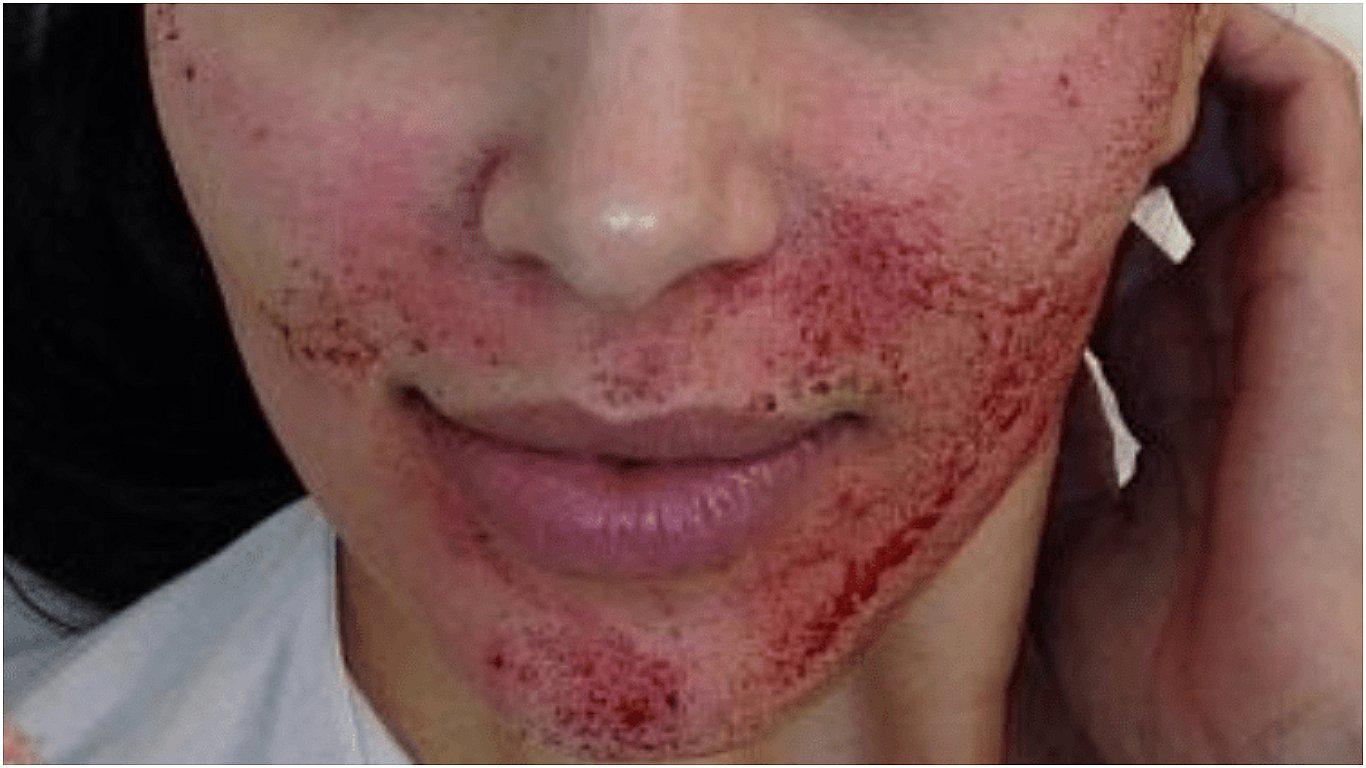 Reportan casos de VIH por supuesta transmisión en tratamiento facial 'vampiro'