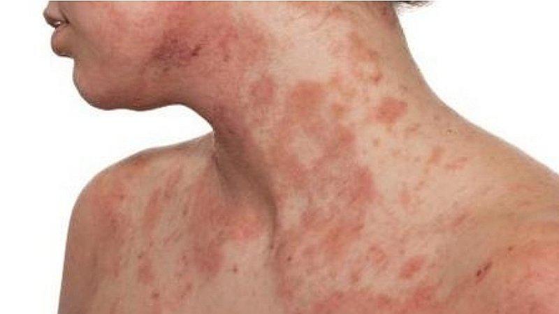 Dermatitis atópica: la enfermedad de la piel que genera depresión y ansiedad