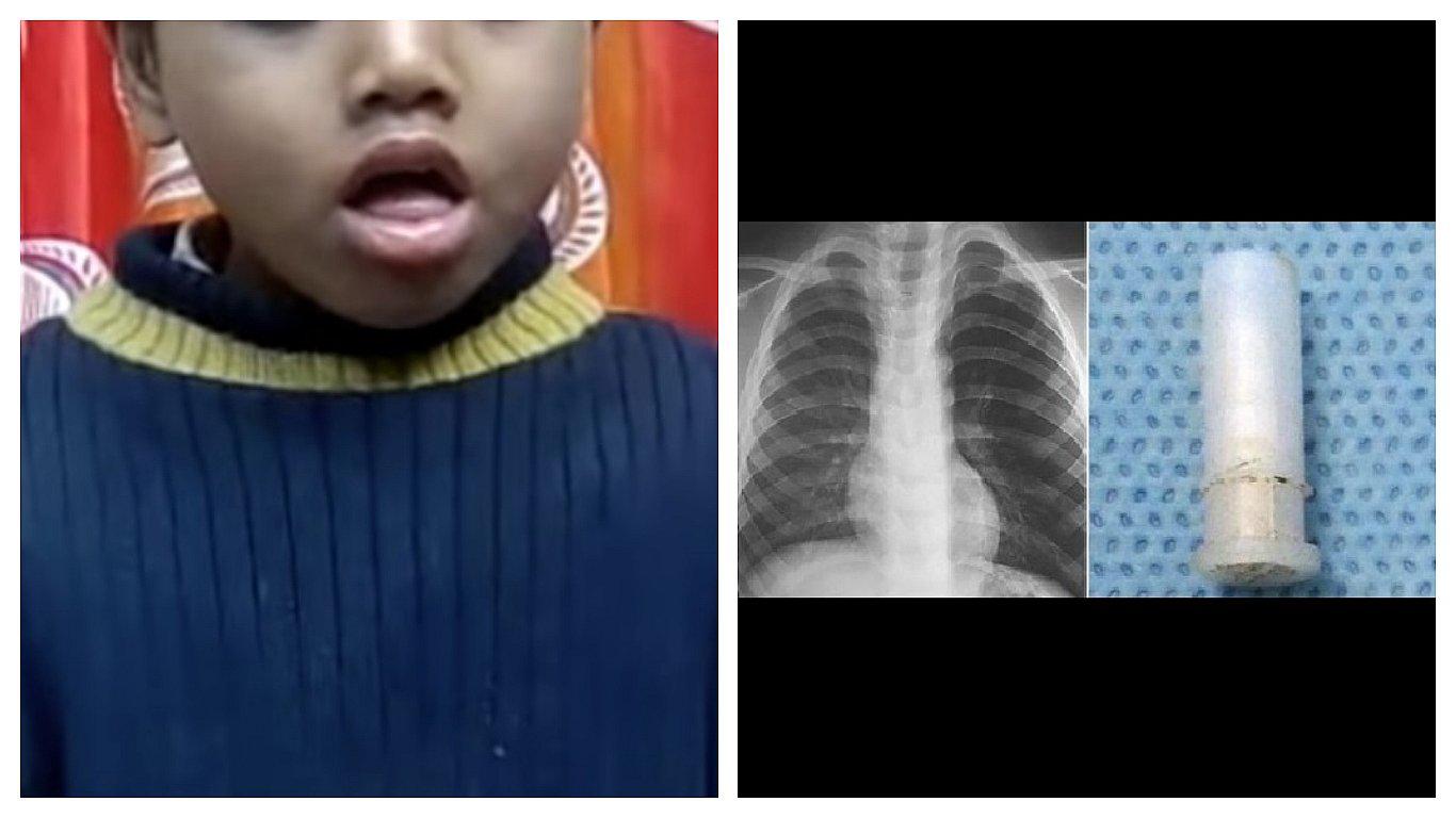 ​Niño se traga silbato y cada vez que tose emite singular sonido (VIDEO)