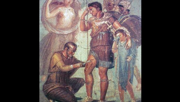 ¿Qué técnicas usaban los antiguos romanos para aliviar el dolor?