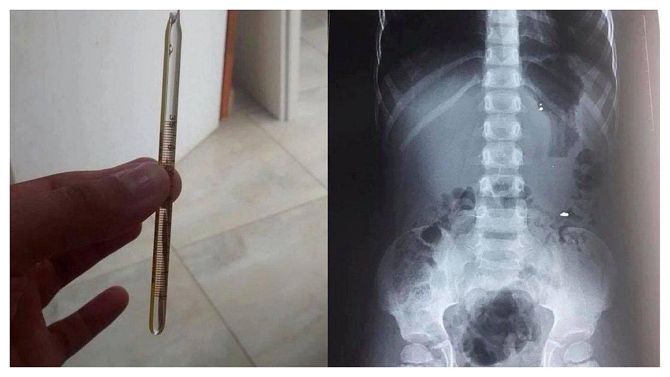 Un niño de cinco años se traga accidentalmente restos de termómetro de mercurio