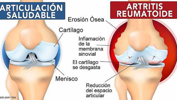 Arequipa: en UCSM descubren cura para la artritis reumatoide