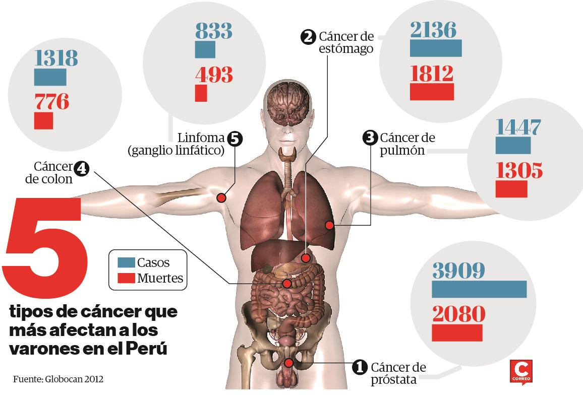 Incidencia de cáncer testicular aumenta en 10% cada año